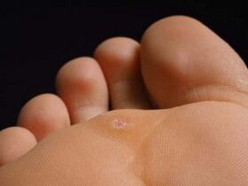 Causes of planar warts