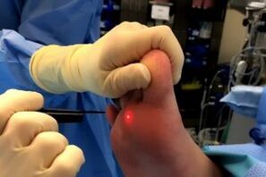 Surgical methods to remove warts