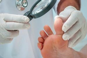 Treatment of planar warts