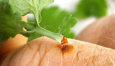How to get a wart with a curtain
