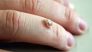 Methods for the treatment of warts with curtains