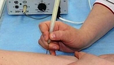 How to get rid of the papillomas on the body