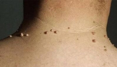 The reasons for the appearance of the papillomas on the human body
