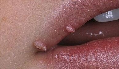 Types of papilloma in man