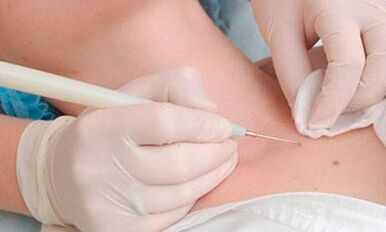 Methods of removing the papillomas on the neck