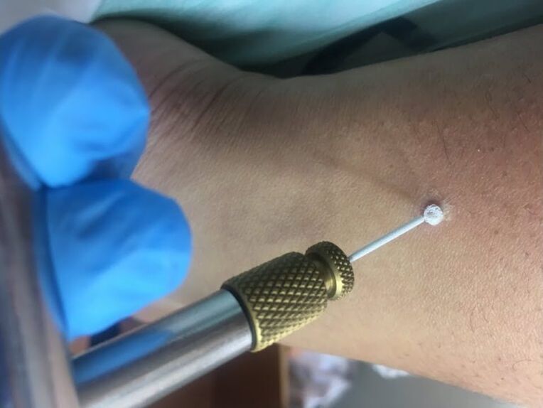 ways to remove warts