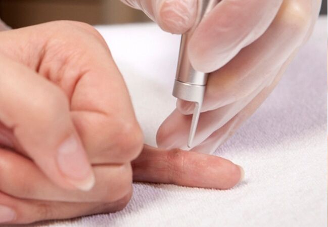 removal of the wart on the finger