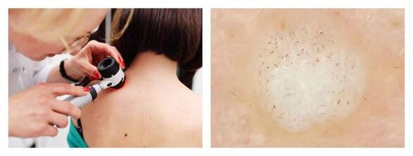 Dermatoscopy of the wart