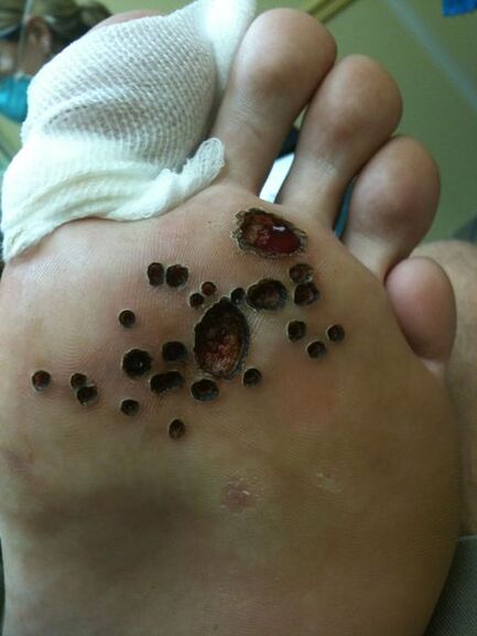 Leather after verties laser removal on the leg