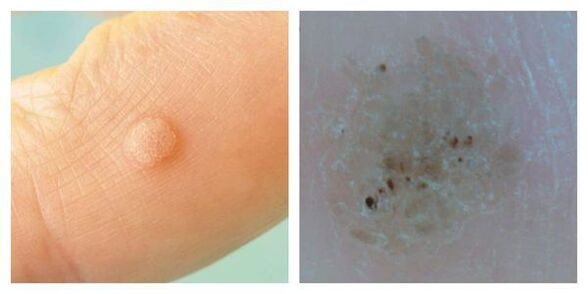 Ordinary wart during the exam and dermatoscopy