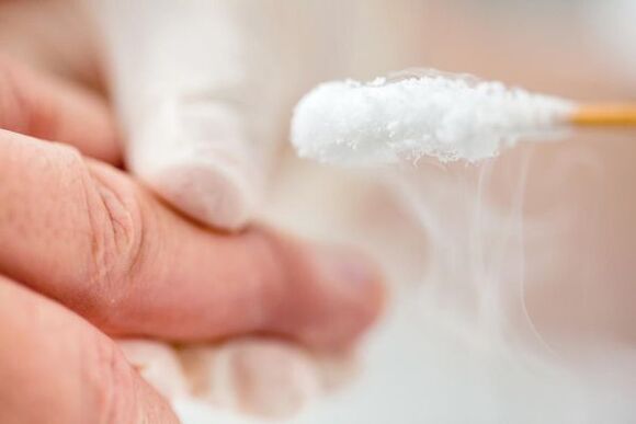 Treatment of the wart with liquid nitrogen