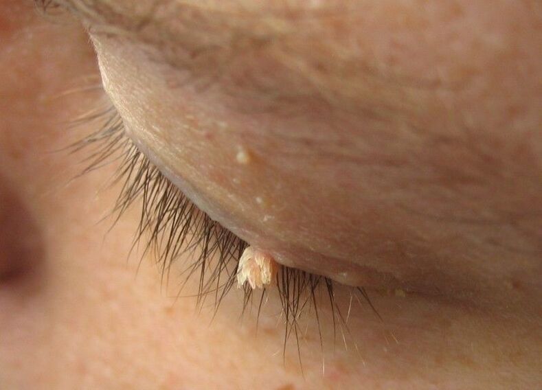 Warts in front of our eyes