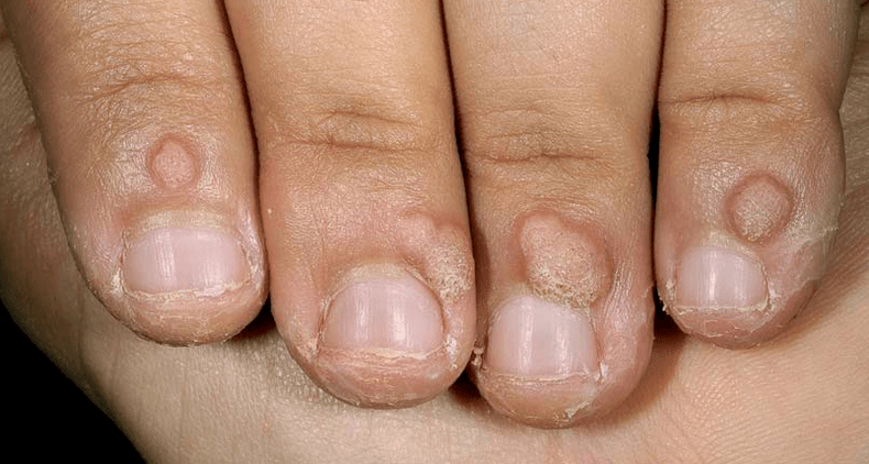 Warts